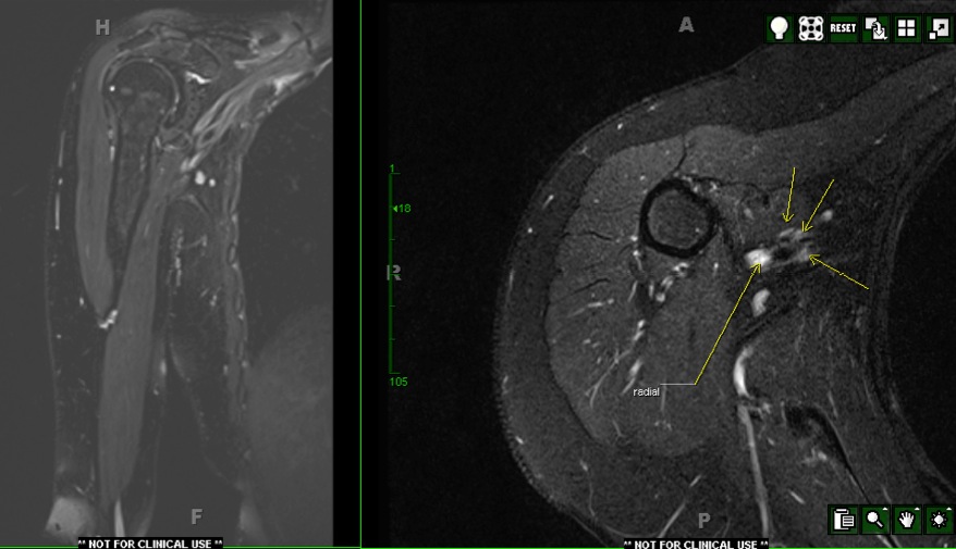Figure 4 for case Multifocal motor neuropathy